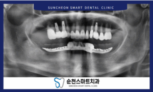 임플란트 식립 전 이미지