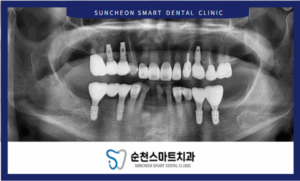 임플란트 식립 후 이미지