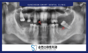 임플란트 식립 전 치료 계획 이미지
