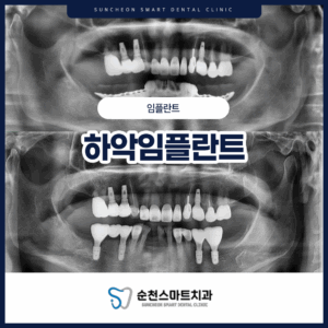 순천보철치료 하악임플란트 치료 전/후