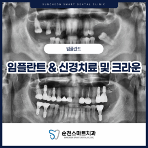 순천치과 임플란트와 신경치료 전/ 후 사진