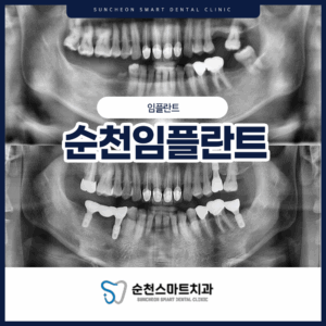 순천임플란트 대표 이미지