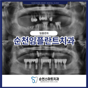순천보철치료 임플란트 치료 전/후 이미지