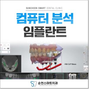 컴퓨터 분석 임플란트 이미지 자료