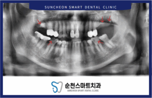 임플란트 전 사진