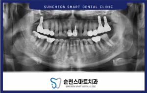임플란트 후 이미지 사진