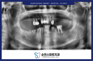 임플란트 치료 전 이미지