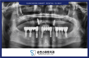 임플란트 식립 후 이미지