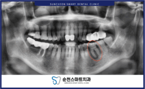 임플란트 식립 전 이미지