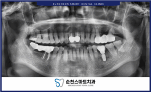임플란트 식립 완료 후 이미지