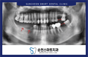 임플란트 식립 전 이미지