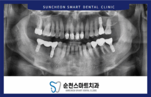 임플란트 식립 후 이미지 사진