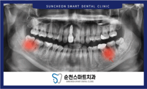 임플란트 치료 전 이미지 자료