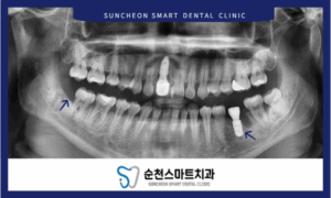 임플란트 치료 후 이미지 자료