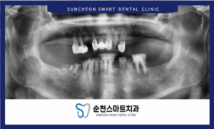 치료 전 임플란트 치료 이미지