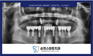 임플란트 치료 후 이미지 사진