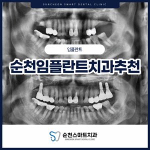 순천임플란트 치료 전/후 이미지