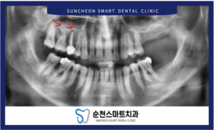 치료를 위한 전 사진