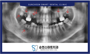 임플란트 식립 전 이미지