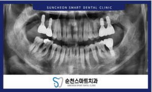 임플란트 식립 후 이미지