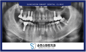 임플란트 식립 후 이미지