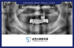 순천임플란트 치료 전