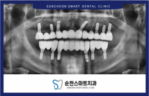 순천임플란트 치료 