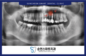 순천보철치료 전