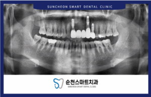 순천보철치료 치료 후