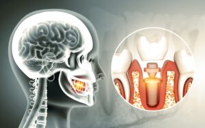 임플란트 이미지