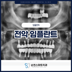 순천임플란트