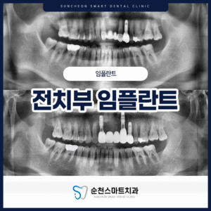 전치부 임플란트 타이틀