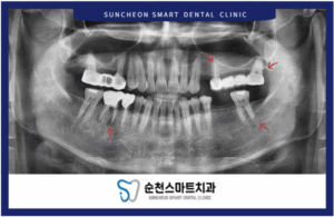 환자의 초진 촬영 이미지