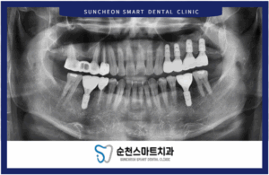 치료가 마무린 된 이미지