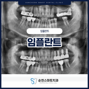 순천치과 임플란트 타이틀