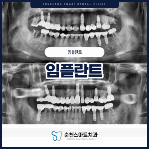 순천보철치료 식립 전후 타이틀