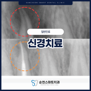 순천치과 신경치료 타이틀 전후