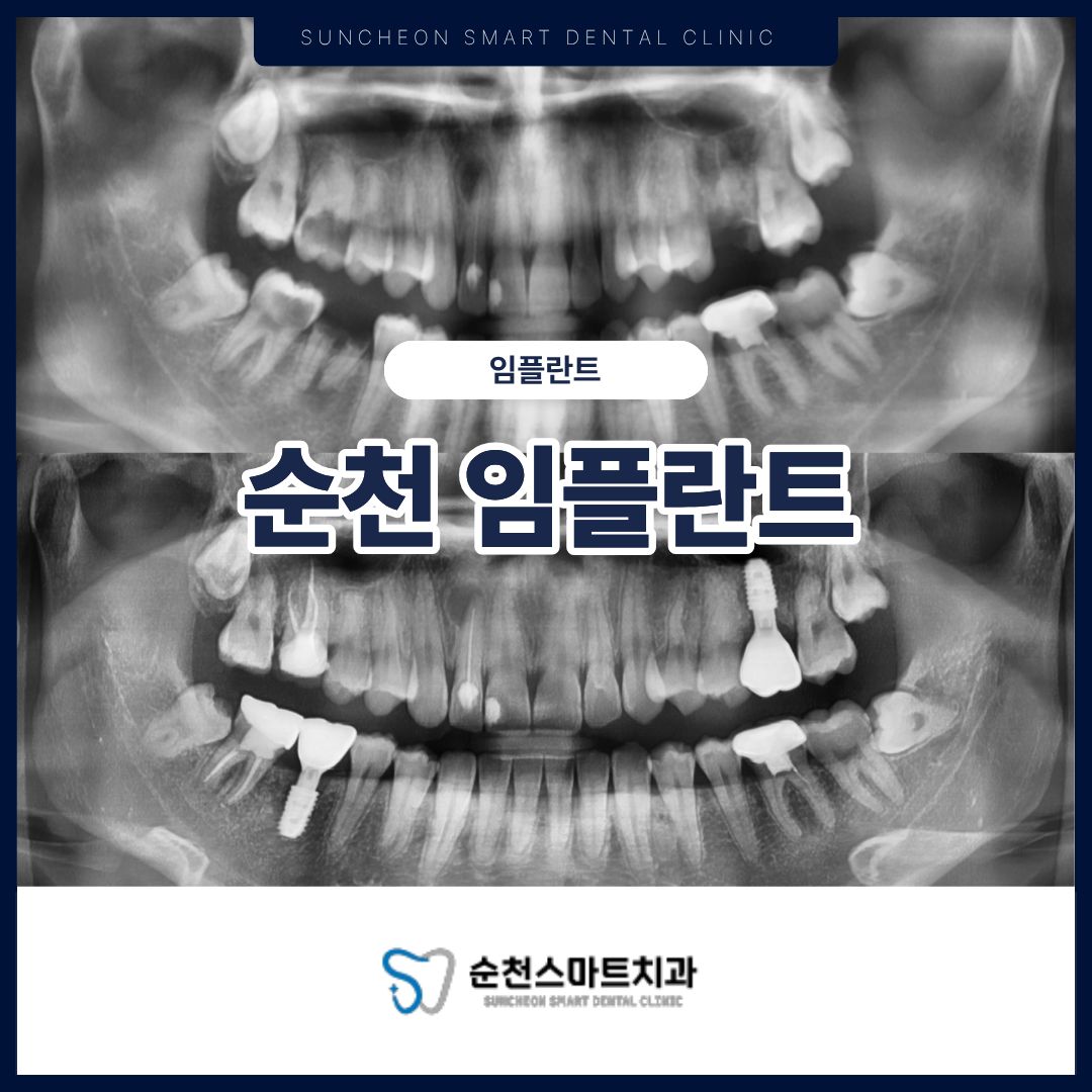 순천임플란트