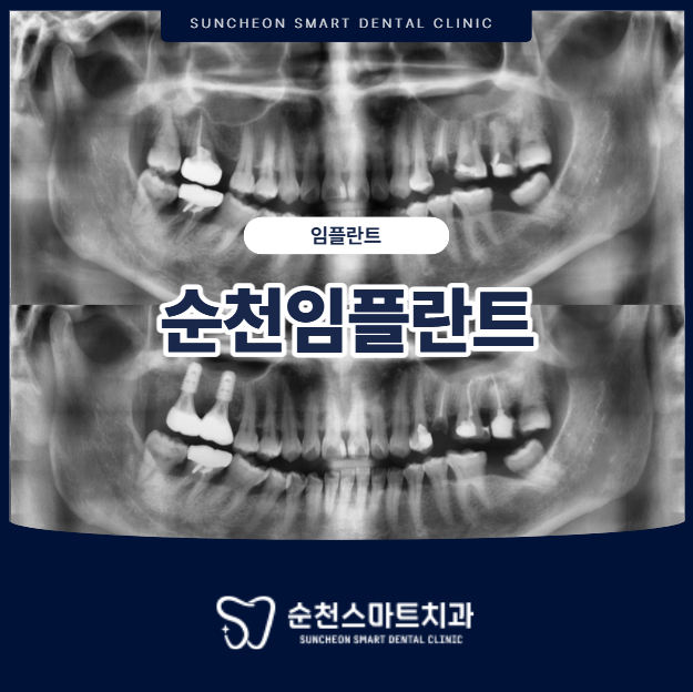 순천임플란트