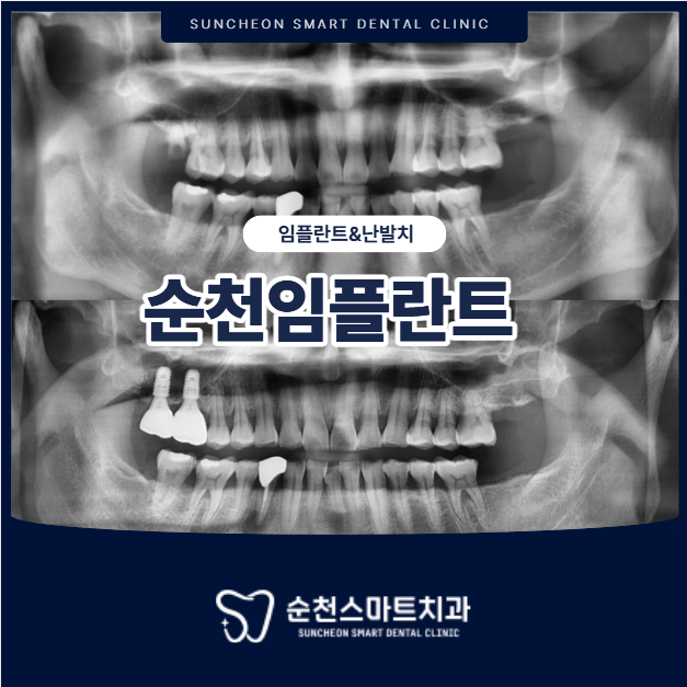 순천임플란트