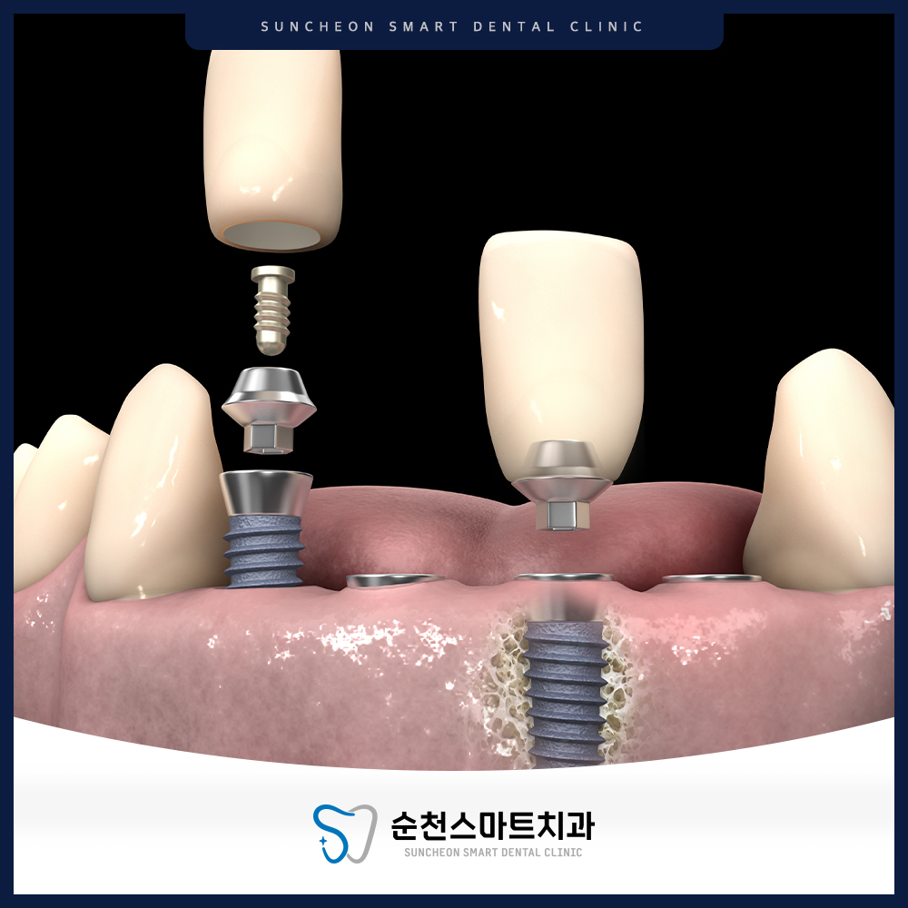 순천임플란트
