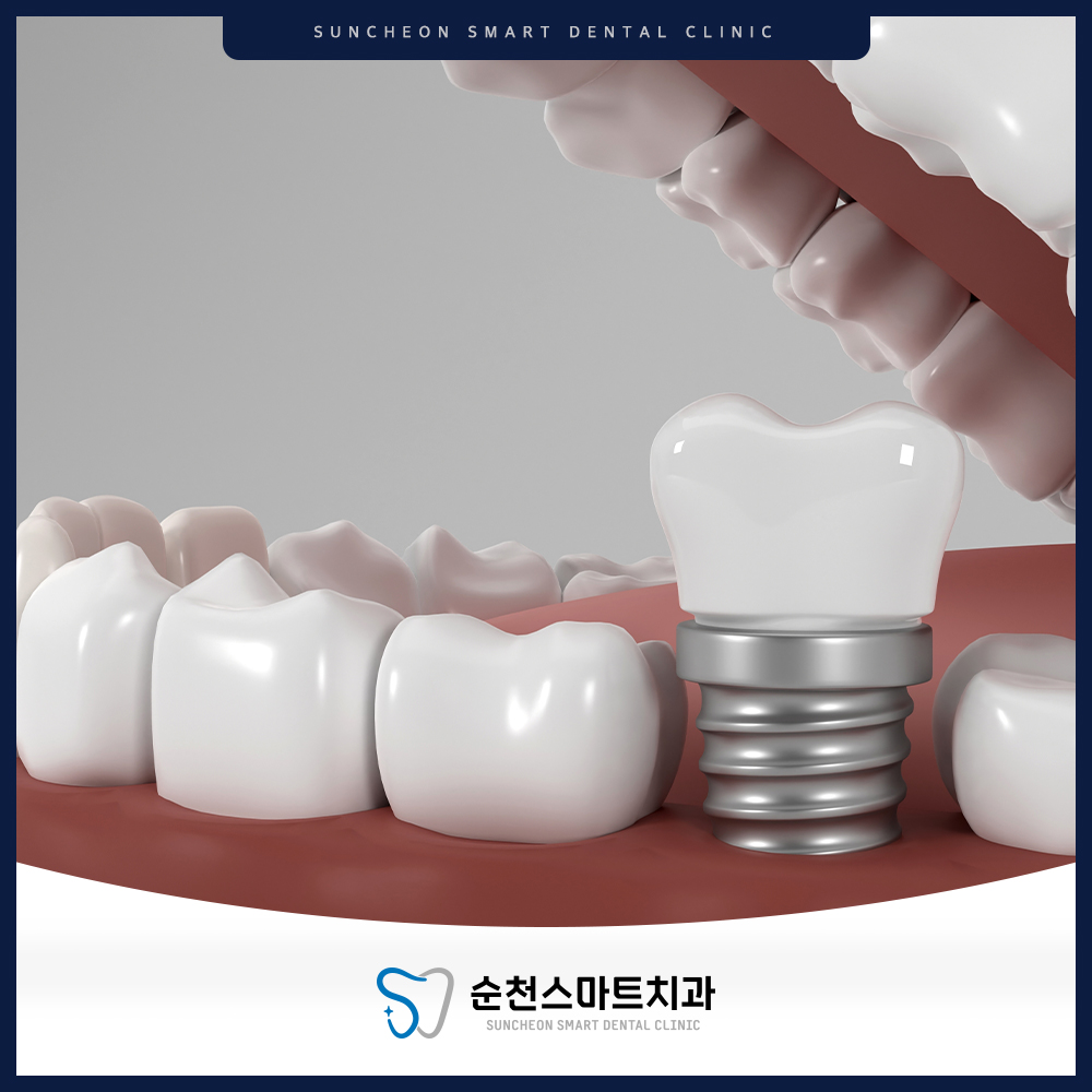 순천임플란트